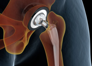 Joint Replacement pic