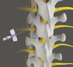 Non-Operative Treatments for Lower Back Injuries pic