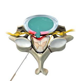 Spine Surgery pic