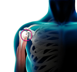 Biceps Tendon Rupture - Educational Picture