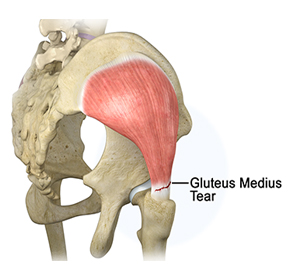 Gluteus Medius Tear - Educational Picture