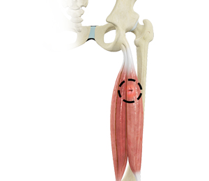 Hamstring Injuries - Educational Picture