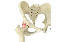 Hip Impingement - Educational Picture