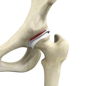 Hip Labral Repair - Educational Picture