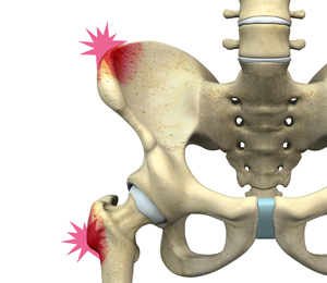 Hip Pointer - Educational Picture