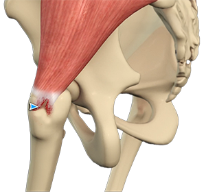 Tendon Injuries - Educational Picture