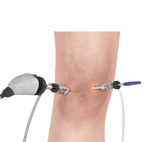 Knee Arthroscopy - Educational Picture