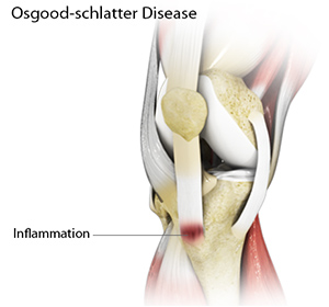Osgood-Schlatter Disease - Educational Picture