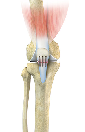 Patellar Tendon Repair - Educational Picture