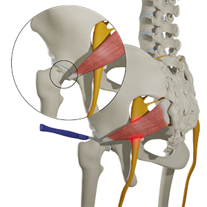 Piriformis Tendon Release - Educational Picture