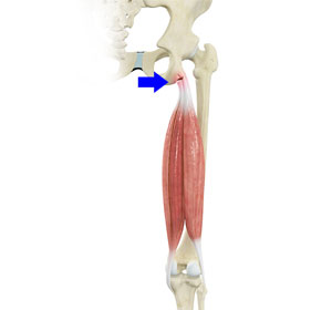 Proximal Hamstring Reconstruction - Educational Picture