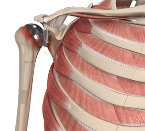 Revision Shoulder Replacement - Educational Picture