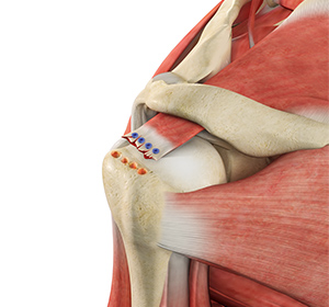 Rotator Cuff Tear - Educational Picture