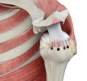 Rotator Cuff Repair - Educational Picture