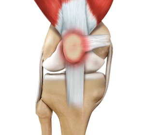 Runner’s Knee - Educational Picture