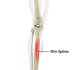 Shin Splints - Educational Picture