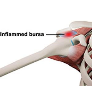 Shoulder Bursitis - Educational Picture