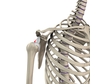 Shoulder Dislocation - Educational Picture