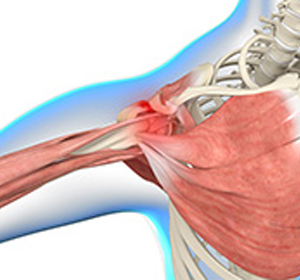 Shoulder Impingement - Educational Picture