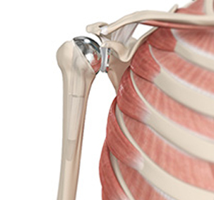Shoulder Joint Replacement - Educational Picture
