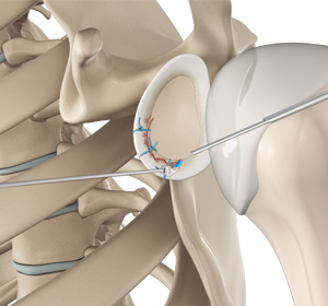 Shoulder Labral Repair - Educational Picture