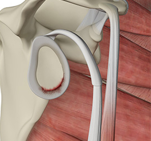 Shoulder Labral Tear - Educational Picture