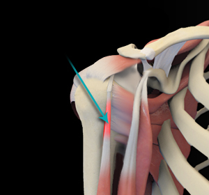 Shoulder Tendonitis - Educational Picture