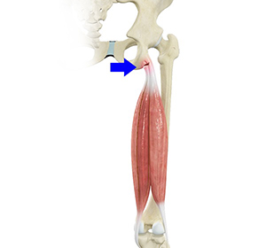 Sprains and Strains - Educational Picture