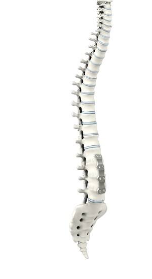 Anterior Lumbar Interbody Fusion pic