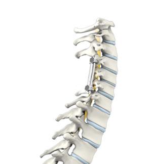 Cervical Laminectomy and Fusion