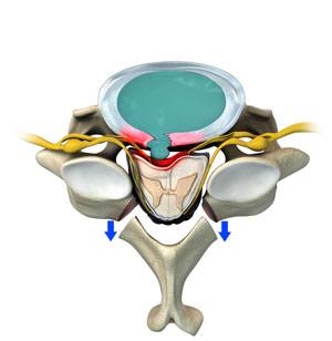 Cervical Laminectomy
