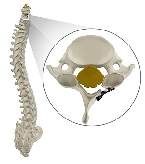 Cervical Laminoplasty