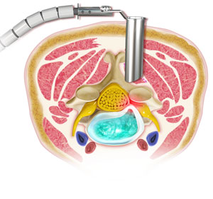 Cervical Microdiscectomy