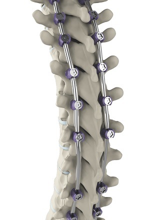 Complex Spine Surgery pic