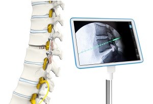Computer Navigated Thoracic Spine Surgery