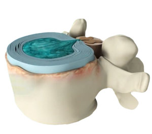 Spinal Disorders pic