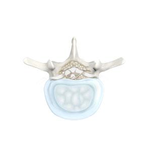 Degenerative Spine Surgery