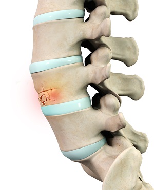 Fractures of the Spine pic