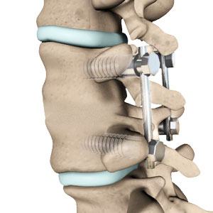 Lumbar Fusion pic