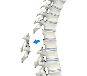 Lumbar Laminectomy pic