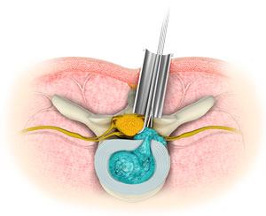 Minimally Invasive Spine Surgery pic