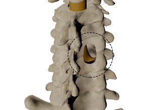 Posterior Cervical Foraminotomy pic