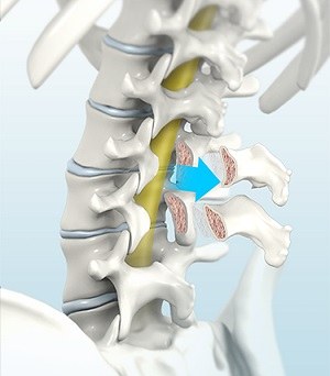 Posterior Lumbar Interbody Fusion pic