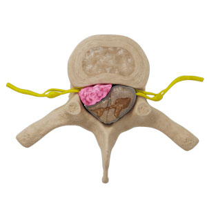 Spinal Cord Compression