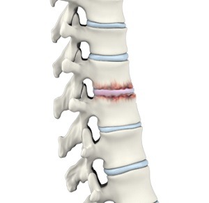 Spine Arthritis pic