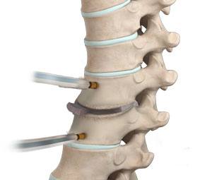 Thoracic Discectomy