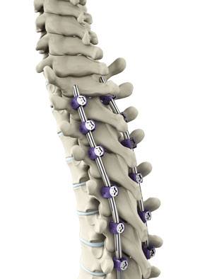 Thoracic Spine Fusion