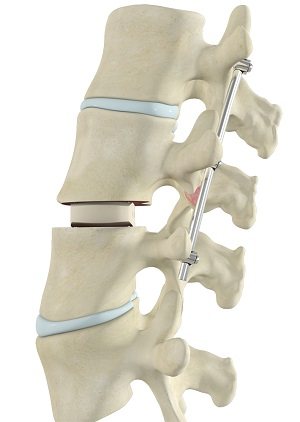 Transforaminal Lumbar Interbody Fusion (TLIF) pic