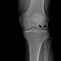Picture of Osteonecrosis of the Knee