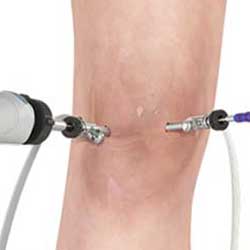 Picture of Arthroscopic Surgery